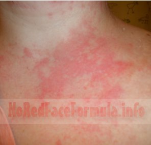 rash from alcohol