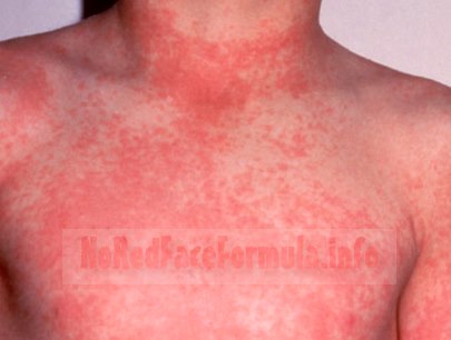 rash on face neck and chest - MedHelp